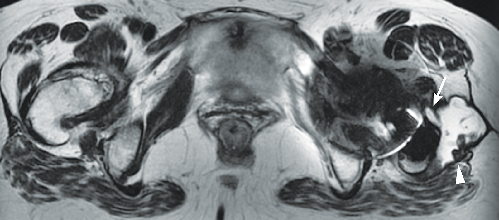 Metal-on-Metal Hip Arthroplasty